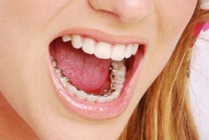 lingual braces 1